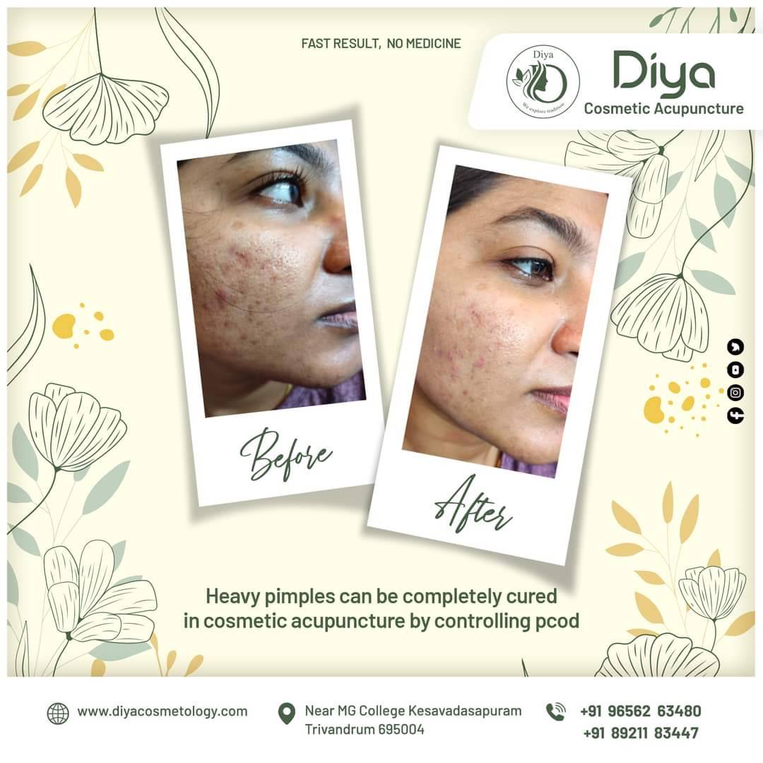 Diya Beauty Spa & Cosmetic Acupuncture in Trivandrum